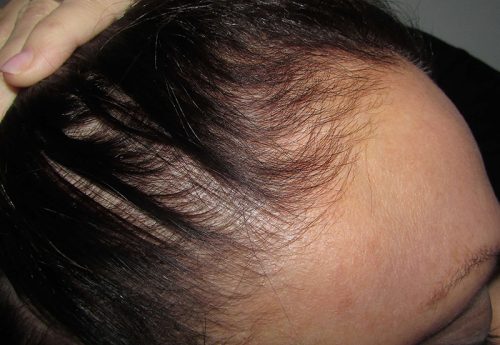 Close up of scalp with alopecia