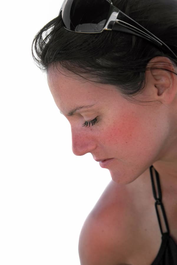 Large pores: 5 causes and how to fix your skin 1 Woman with sunburn which can exacerbate large pores